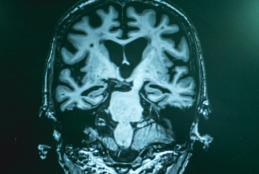 Advanced Alzheimer’s disease can be seen on brain scans, but gathering more data could allow for earlier diagnosis and treatment. Shutterstock/Rakstaput
